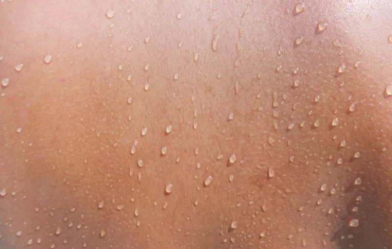 17 Juin Comment aider les peaux deshydratees 1512x | Absology Compléments alimentaires