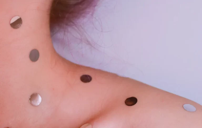 29 Avril Acne alternate 2 1512x | Absology Compléments alimentaires